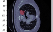 دیتاست ناحیه‌بندی تومور ریه - Decathlon Lung Tumor