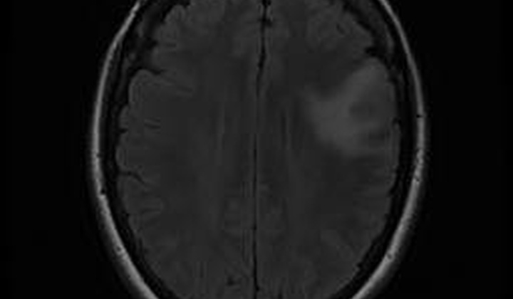 مجموعه داده های MRI تومور مغزی - ناحیه‌بندی