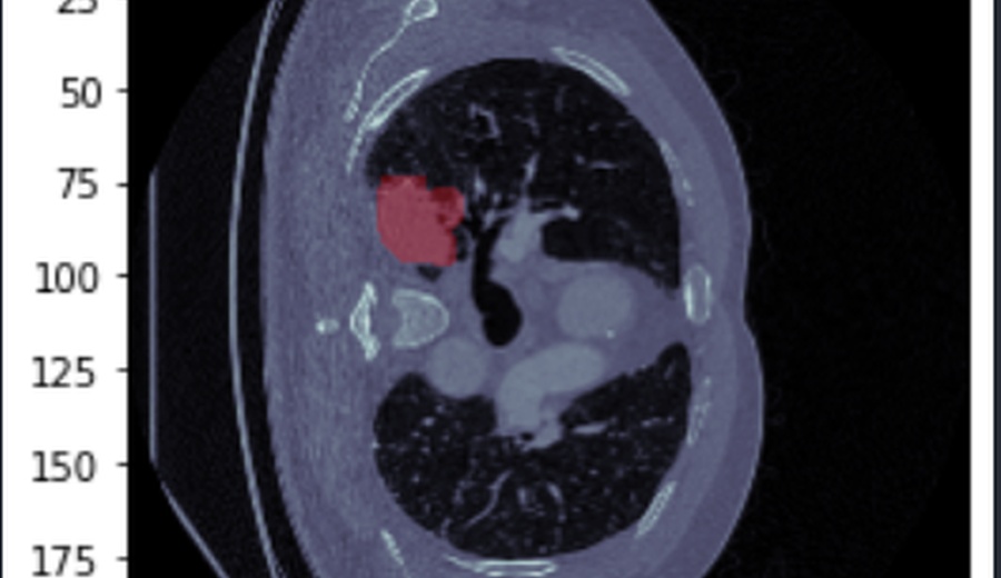 دیتاست ناحیه‌بندی تومور ریه - Decathlon Lung Tumor