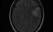 مجموعه داده های MRI تومور مغزی - ناحیه‌بندی