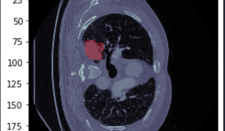 دیتاست ناحیه‌بندی تومور ریه - Decathlon Lung Tumor