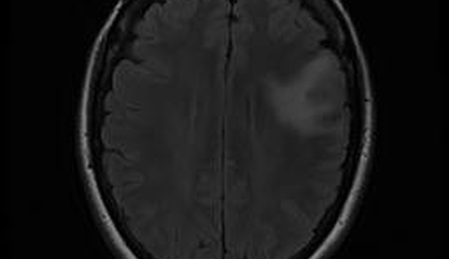 مجموعه داده های MRI تومور مغزی - ناحیه‌بندی