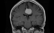 مجموعه ۸۳۰۰ عددی MRI تشخیص تومور مغزی با فرمت YOLO