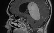 مجموعه ۸۳۰۰ عددی MRI تشخیص تومور مغزی با فرمت YOLO