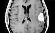 مجموعه ۸۳۰۰ عددی MRI تشخیص تومور مغزی با فرمت YOLO