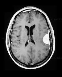 مجموعه ۸۳۰۰ عددی MRI تشخیص تومور مغزی با فرمت YOLO