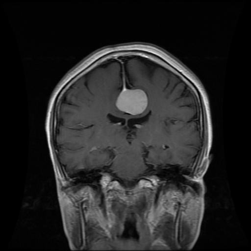 مجموعه ۸۳۰۰ عددی MRI تشخیص تومور مغزی با فرمت YOLO